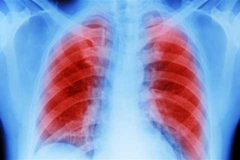 Can asbestosis turn into mesothelioma?