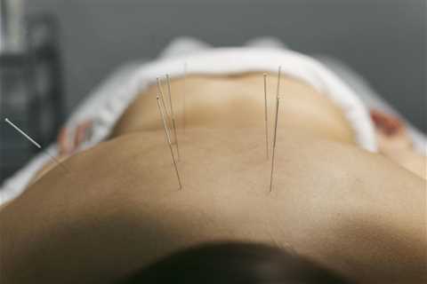 HOW TO CHOOSE THE RIGHT ACUPUNCTURE NEEDLE SIZE