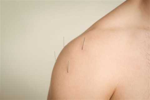 THE BENEFITS OF ACUPUNCTURE FOR CHRONIC PAIN IN POLYMYALGIA RHEUMATICA PATIENTS ON LOW-DOSE..