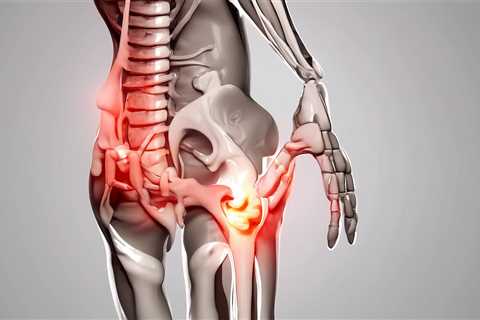 What Is The Average Payout For Sciatica Pain?